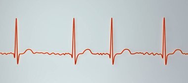 Atriyal fibrilasyonda ECG (AFib), düzensiz ritim, P dalgaları yokluğu ve hızlı, kaotik atriyal aktivite, çarpıntı ve felç riski içeren üç boyutlu bir illüstrasyondur..