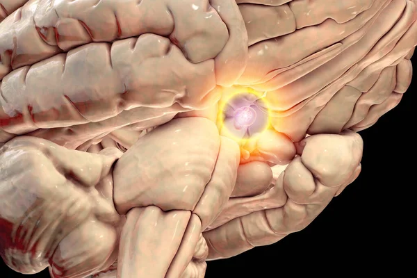 Pituitary Gland Tumor Medical Illustration Highlighting Its Location Impact Nearby — Stock Photo, Image