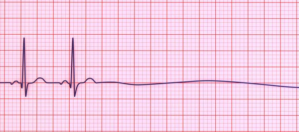 Asystole Critical Condition Marked Absence Any Cardiac Electrical Activity Illustration — Stock Photo, Image