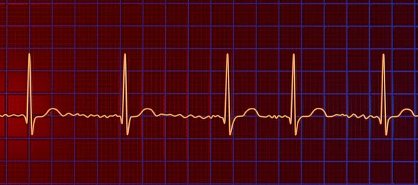 stock image ECG in atrial fibrillation (AFib), a 3D illustration depicts irregular rhythm, absent P waves, and rapid, chaotic atrial activity, posing a risk of palpitations and stroke.