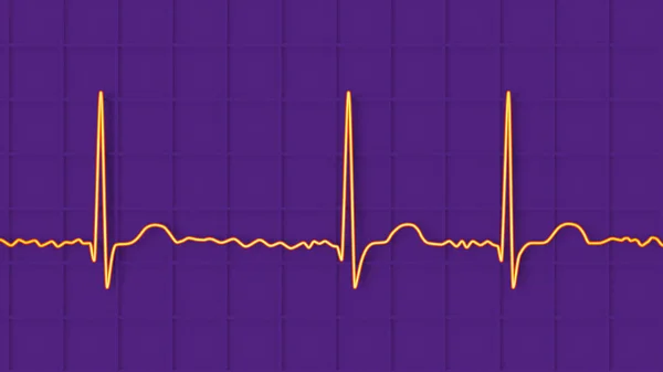 Ecg Atrial Fibrillation Afib Illustration Depicts Irregular Rhythm Absent Waves — Stock Photo, Image