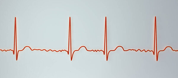 ECG in atrial fibrillation (AFib), a 3D illustration depicts irregular rhythm, absent P waves, and rapid, chaotic atrial activity, posing a risk of palpitations and stroke.