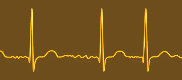 Ecg Atrial Fibrillation Afib Illustration Depicts Irregular Rhythm Absent Waves — Stock Photo, Image