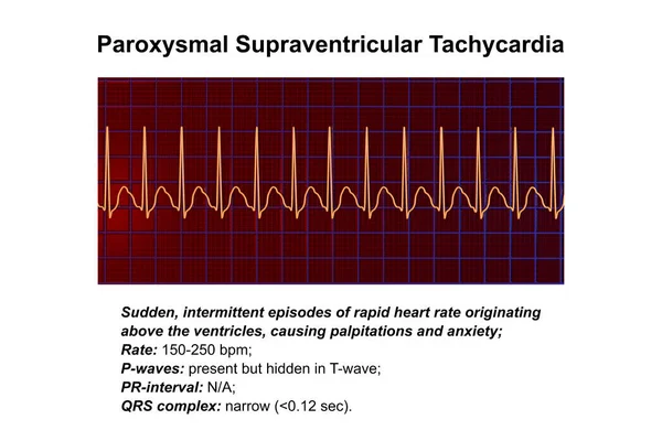 ECG in supraventricular tachycardia, a rapid heart rate originating above the ventricles, causing palpitations and dizziness. 3D illustration shows narrow QRS complexes and P waves hidden in T waves.