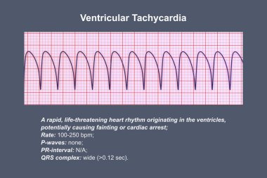 Ventricular tachycardia: A rapid heart rhythm originating in the ventricles, causes palpitations, dizziness, and life-threatening symptoms. ECG shows wide QRS complexes, 3D illustration. clipart