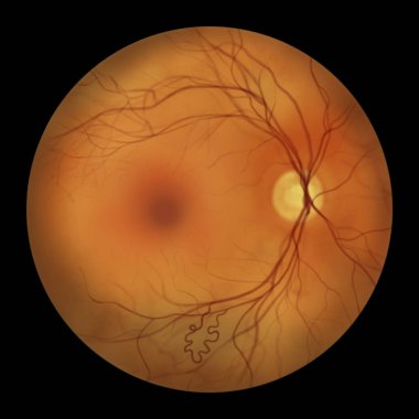 Retinal arteriovenöz malformasyon: retinadaki karışık kan damarları ile ender rastlanan retinal vasküler anomaliler, illüstrasyon kılcal damarlara müdahale edilmeden arter damarı iletişimini gösteriyor.
