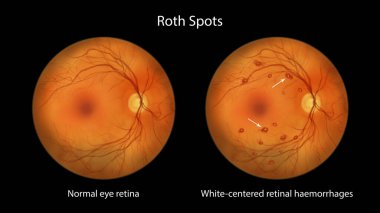 Göz muayenesi sırasında görülen retinadaki Roth lekeleri, beyaz merkezli retinal kanamaları ve çevresindeki kanamaları gösteren bir çizim..