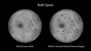 Retinada, floresan anjiyogramında görüldüğü gibi, göz çukurunda beyaz merkezli retina kanamaları ve çevresindeki kanamaları gösteren bir çizim var..