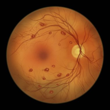 Göz muayenesi sırasında gözlemlendiği üzere retinadaki Roth lekeleri beyaz merkezli retinal kanamaları ve çevresindeki kanamaları gösteriyor..