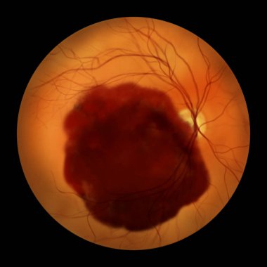 Göz muayenesi sırasında gözlenen bir iç kanamanın tıbbi göstergesi retina tabakalarının altında koyu ve düzensiz bir kanama olduğunu gösteriyor..