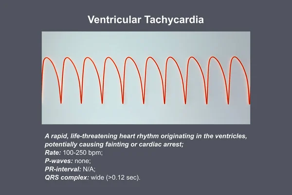Taquicardia Ventricular Ritmo Cardíaco Rápido Que Origina Nos Ventrículos Causa — Fotografia de Stock