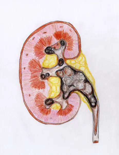 Kidney Stones Hand Drawing Illustration Depicts Section Human Kidney Containing — Stock Photo, Image