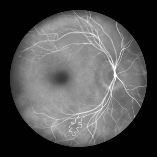Retinal Arteriovenous Malformation Rare Congenital Retinal Vascular Anomalies Illustration Shows — Stock Photo, Image