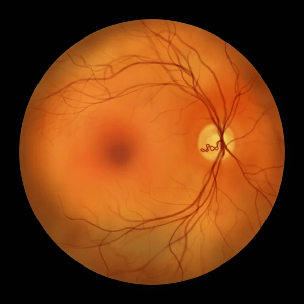 Prepapillary Vascular Loop Retina Observed Ophthalmoscopy Illustration Showcasing Looping Blood — Stock Photo, Image