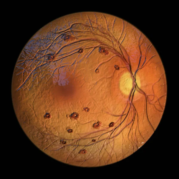 Roth Spots Retina Seen Ophthalmoscopy Illustration Showing White Centered Retinal — Stock Photo, Image