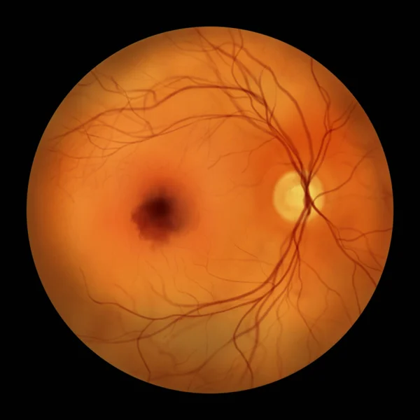Medical Illustration Submacular Hemorrhage Observed Ophthalmoscopy Showcasing Dark Irregularly Shaped — Stock Photo, Image