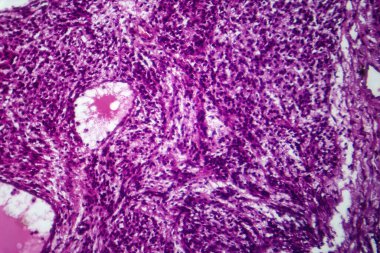 Fibrosarkom 'un fotomikroskobu kötü huylu fibroblastlar ve kolajen zengini bağ dokusu gösteriyor. Agresif yumuşak doku kanserinin karakteristiği..