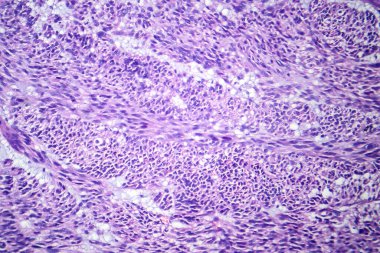 Leiomyoma 'nın fotomikrografı rahim dokusundaki iyi huylu, pürüzsüz kas tümörü hücrelerini gösteriyor..