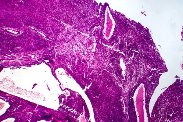 Photomicrograph of fibrosarcoma, revealing malignant fibroblasts and collagen-rich connective tissue, characteristic of aggressive soft tissue cancer.