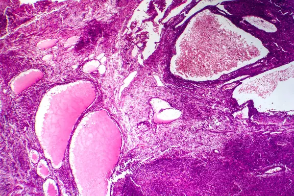 纤维肉瘤的显微照片 揭示恶性成纤维细胞和富含胶原蛋白的结缔组织 具有侵袭性软组织癌的特征 — 图库照片