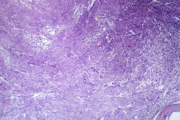 Fotografische Aufnahme Des Leiomyoms Die Gutartige Tumorzellen Der Glatten Muskulatur — Stockfoto