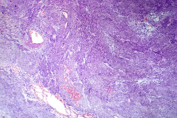 Photomicrograph of leiomyoma, illustrating benign smooth muscle tumor cells within the uterine tissue.
