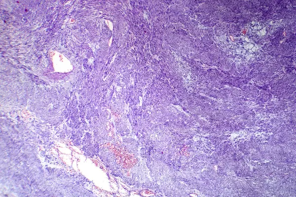 子宮組織内の良性滑らかな筋肉腫瘍細胞を示すレイオマイオマの光学グラフ — ストック写真