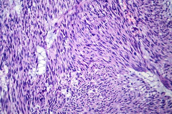 Photomicrograph Leiomyoma Illustrating Benign Smooth Muscle Tumor Cells Uterine Tissue — Stock Photo, Image