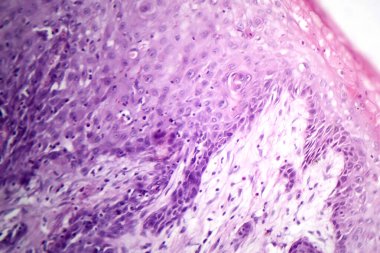 Midede mukoza kanserinin fotomikroskobu, kötü huylu muksin üreten hücreler gösteriyor, agresif mide kanserinin karakteristiği..