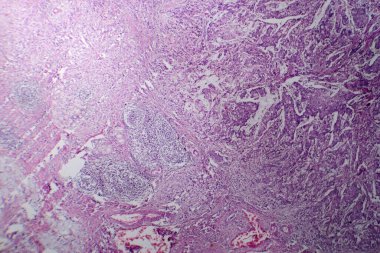 Midede mukoza kanserinin fotomikroskobu, kötü huylu muksin üreten hücreler gösteriyor, agresif mide kanserinin karakteristiği..