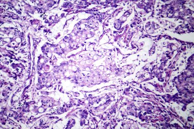 Midede mukoza kanserinin fotomikroskobu, kötü huylu muksin üreten hücreler gösteriyor, agresif mide kanserinin karakteristiği..