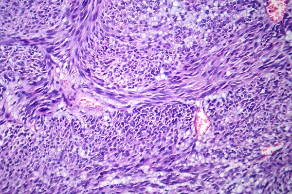 子宫肌瘤的显微照片 显示子宫组织中良性平滑肌肿瘤细胞 — 图库照片