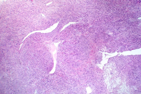 Fotomicrografia Leiomiossarcoma Que Descreve Células Tumorais Malignas Músculo Liso Indicativas — Fotografia de Stock