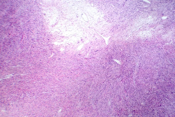 공격적인 부드러운 조직암을 나타내는 부드러운 세포를 묘사하는 레이오미요사르코마의 포토그래프 — 스톡 사진
