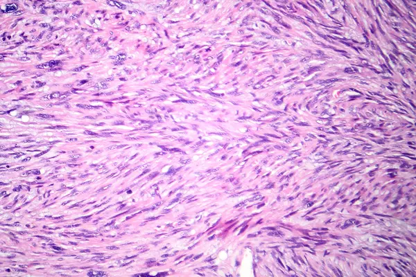 Photomicrograph Leiomyosarcoma Depicting Malignant Smooth Muscle Tumor Cells Indicative Aggressive — Stock Photo, Image
