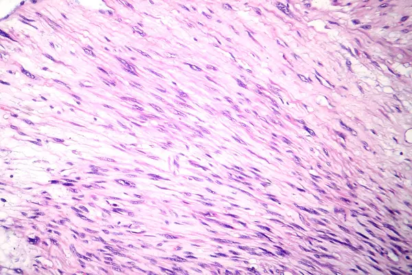 Fotomikrografi Leiomyosarkom Föreställande Maligna Glatta Muskeltumörceller Indikerar Aggressiv Mjukvävnadscancer — Stockfoto