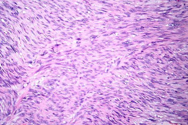悪性滑らかな筋肉腫瘍細胞を描いたレオミヨアコメアの写真グラフ 積極的な軟組織癌を示す — ストック写真