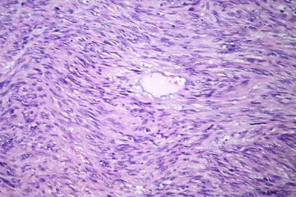 Photomicrograph of leiomyosarcoma, depicting malignant smooth muscle tumor cells, indicative of aggressive soft tissue cancer.