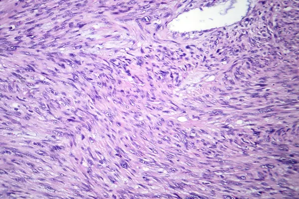 平滑肌肉瘤的显微照片 描绘平滑肌恶性肿瘤细胞 表现为侵袭性软组织癌 — 图库照片