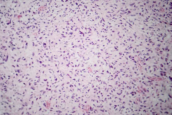 Photomicrograph of malignant cells, revealing abnormal and uncontrolled cellular growth indicative of cancerous development.