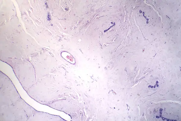 纤维腺瘤的显微照片 显示乳腺内良性腺体和纤维组织的生长 这是一种常见的非癌组织 — 图库照片
