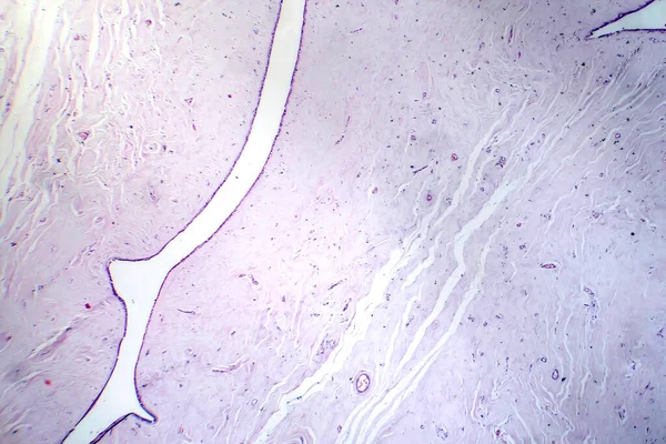 Fotomicrografía Fibroadenoma Que Muestra Crecimiento Glandular Fibroso Benigno Dentro Mama — Foto de Stock