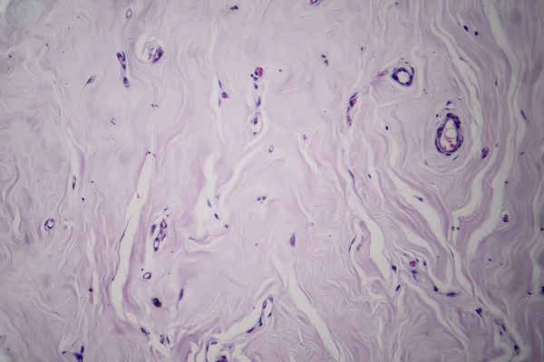 Photomicrograph of fibroadenoma, showcasing benign glandular and fibrous tissue growth within the breast, a common noncancerous tumor.