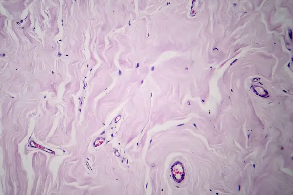 Photomicrograph of fibroadenoma, showcasing benign glandular and fibrous tissue growth within the breast, a common noncancerous tumor.