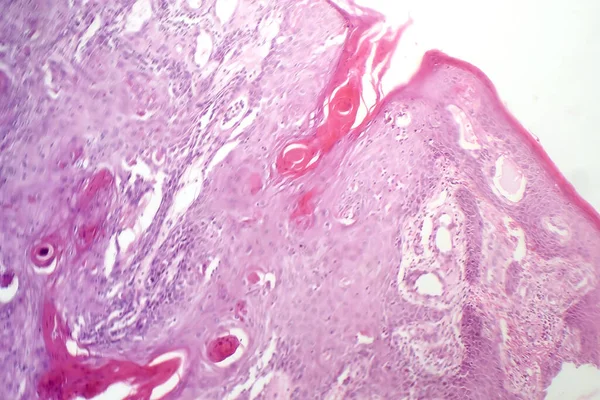 Gyomornyálkahártya Karcinóma Fotomikrográfja Amely Rosszindulatú Nyálkahártya Termelő Sejteket Mutat Ami — Stock Fotó