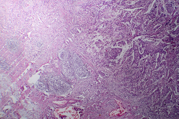 Photomicrograph of mucinous carcinoma in the stomach, displaying malignant mucin-producing cells, characteristic of an aggressive stomach cancer.
