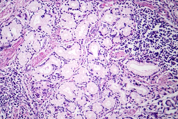 Gyomornyálkahártya Karcinóma Fotomikrográfja Amely Rosszindulatú Nyálkahártya Termelő Sejteket Mutat Ami — Stock Fotó