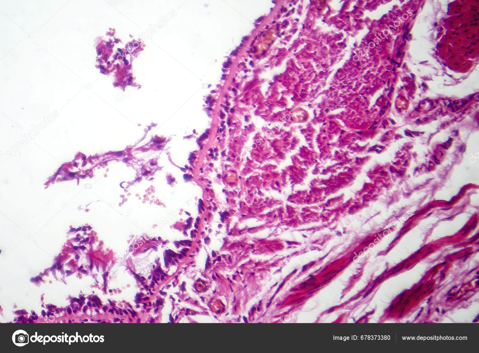 Photomicrograph Chronic Bronchitis Showing Inflamed Bronchial Lining 