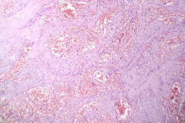 Kılcal hemanjiyomun fotomikrografı, kılcal damarların anormal çoğaldığını gösteriyor, iyi huylu vasküler tümörün karakteristiği..