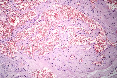 Kılcal hemanjiyomun fotomikrografı, kılcal damarların anormal çoğaldığını gösteriyor, iyi huylu vasküler tümörün karakteristiği..